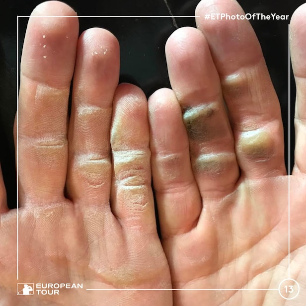 You need to see the callouses on this pro golfer's hands Golf News